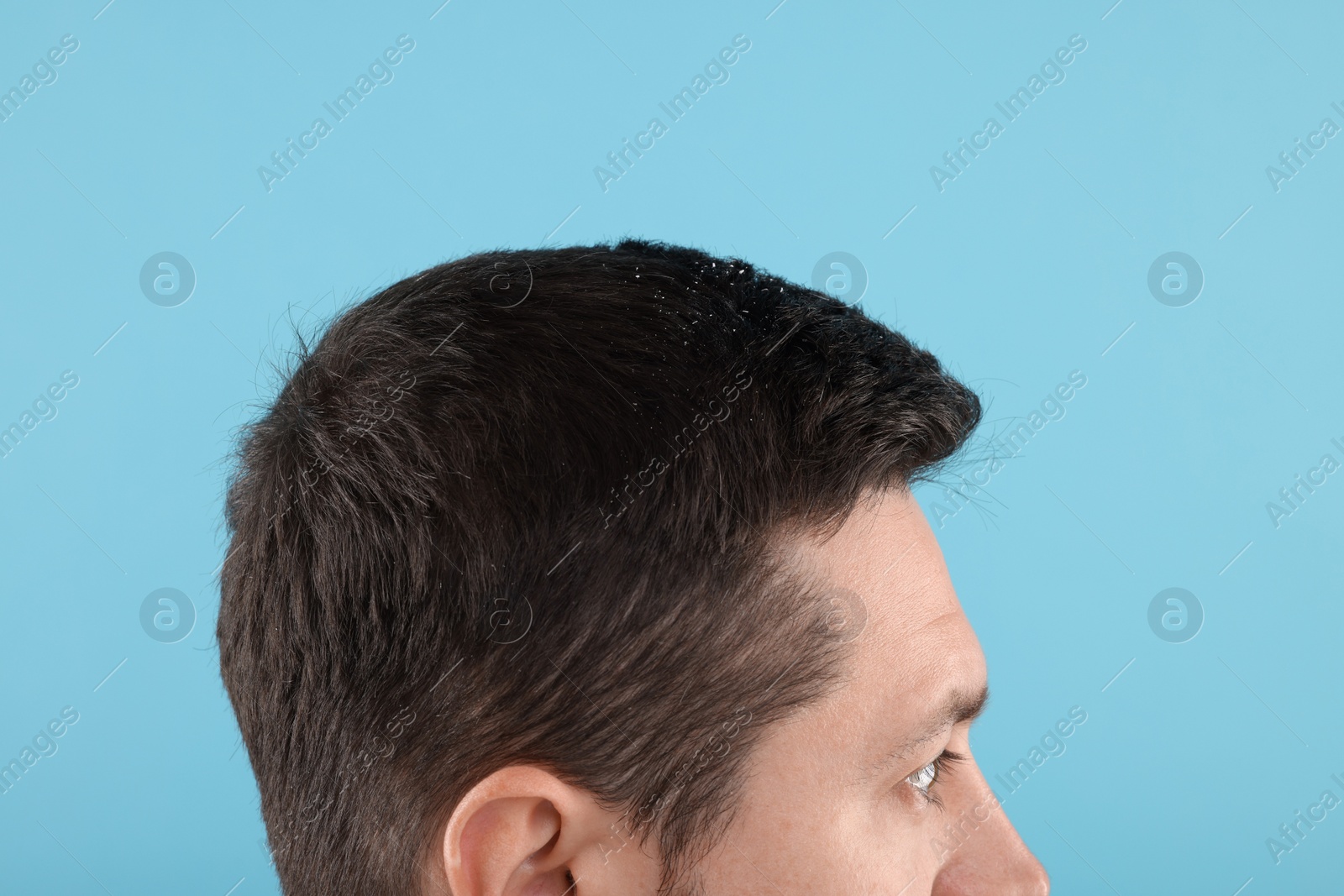 Photo of Man with dandruff in his dark hair on light blue background, closeup