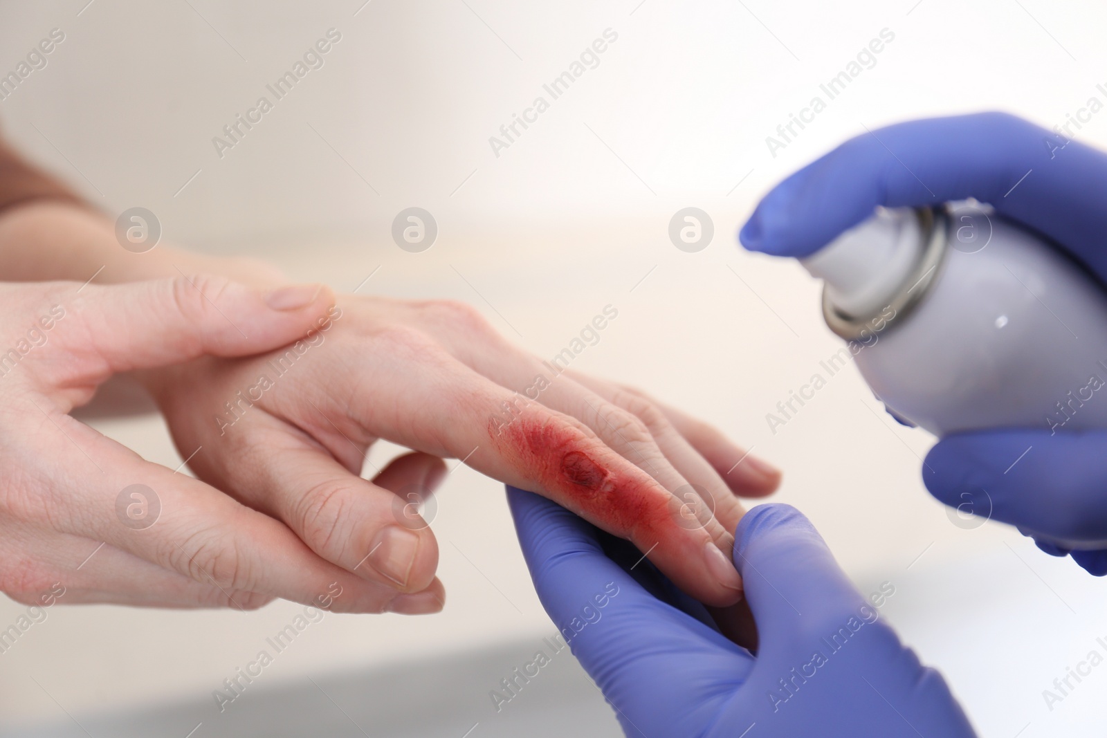 Photo of Applying burn spray onto injured skin, closeup