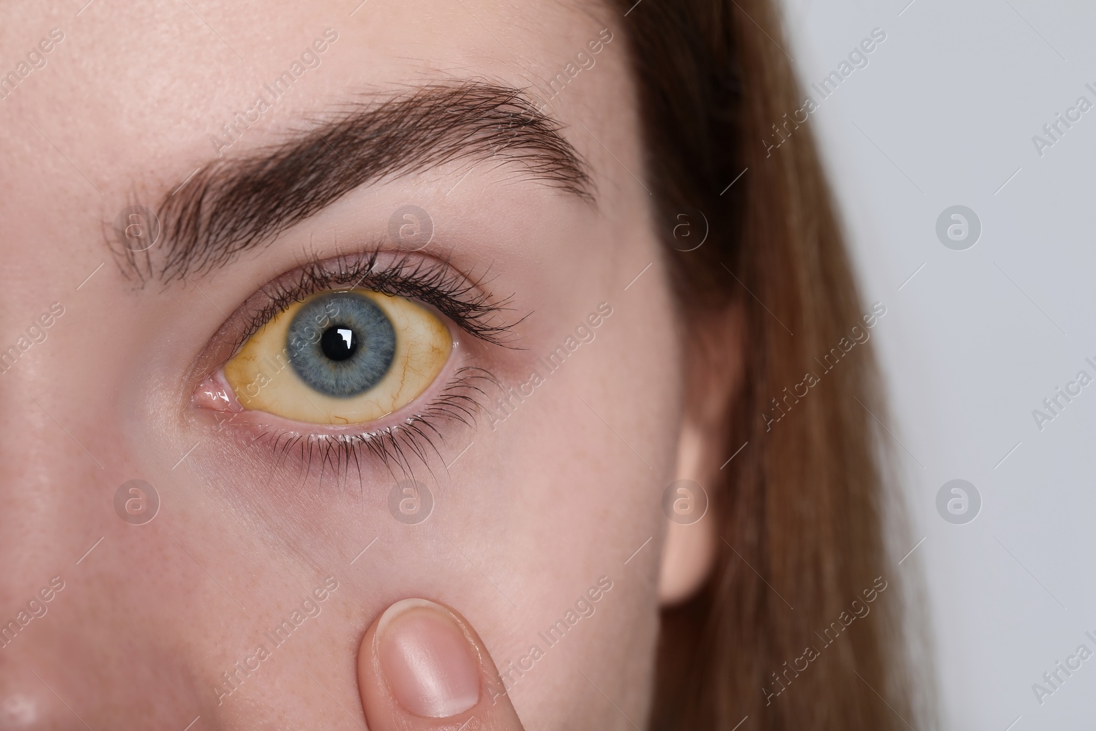 Photo of Woman with yellow eyes on white background, closeup. Symptom of hepatitis