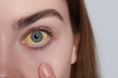 Photo of Woman with yellow eyes on white background, closeup. Symptom of hepatitis