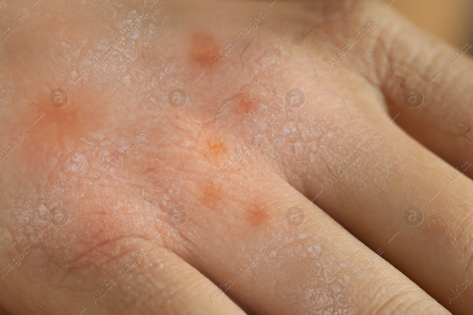 Image of Closeup view of person with dry skin on hand