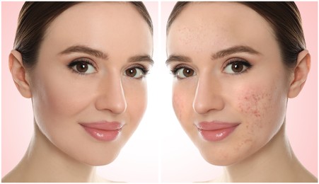 Image of Young woman with acne problem before and after treatment on light background, collage. Banner design