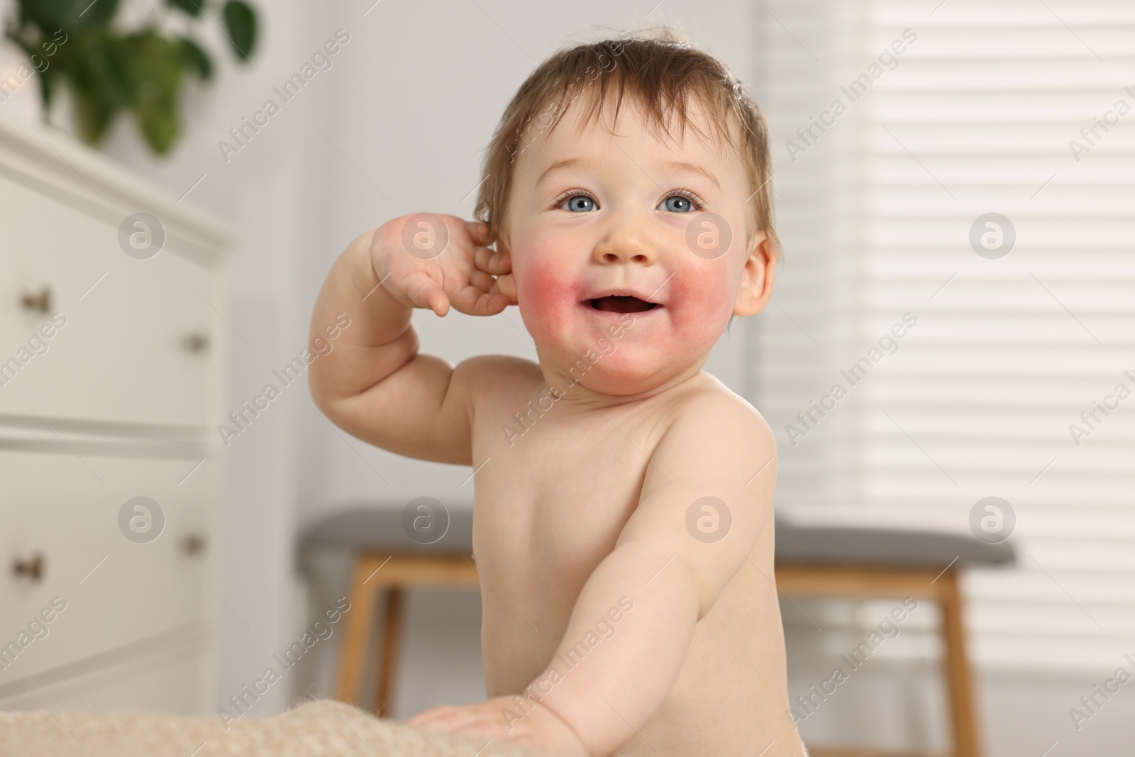 Photo of Cute little baby with allergic redness on cheeks indoors