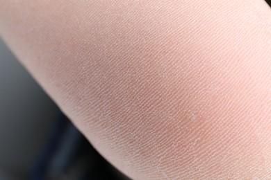 Woman with dry skin on foot, closeup