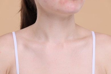 Photo of Closeup view of woman with healthy skin on beige background