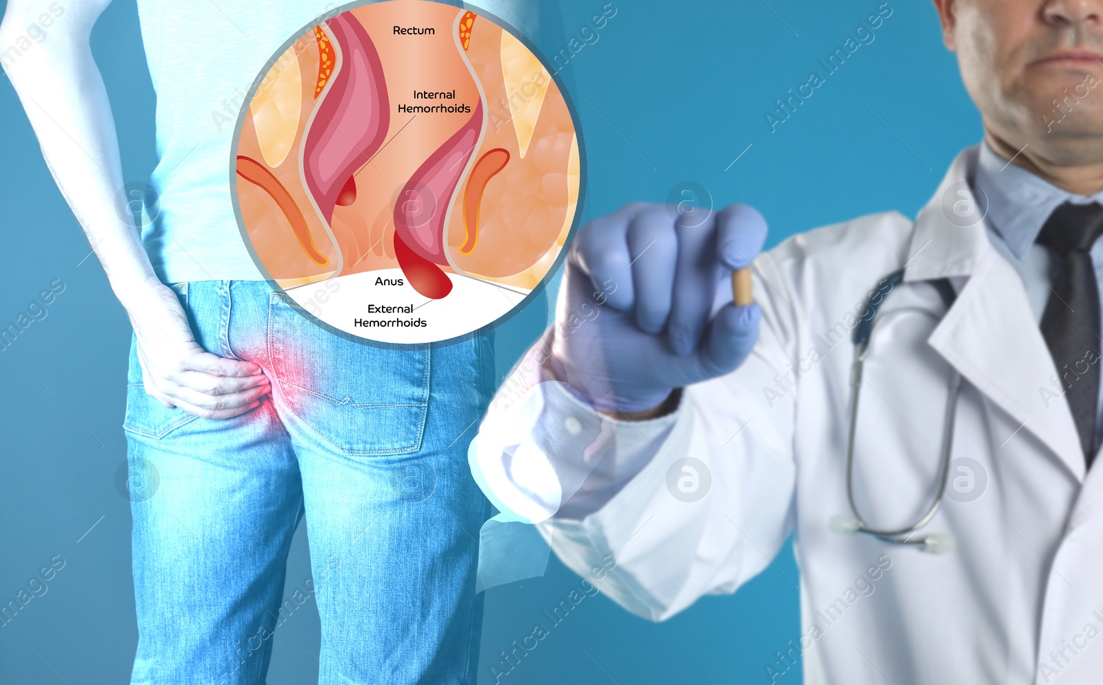Image of Doctor holding suppository near man suffering from hemorrhoid pain. Illustration of unhealthy lower rectum