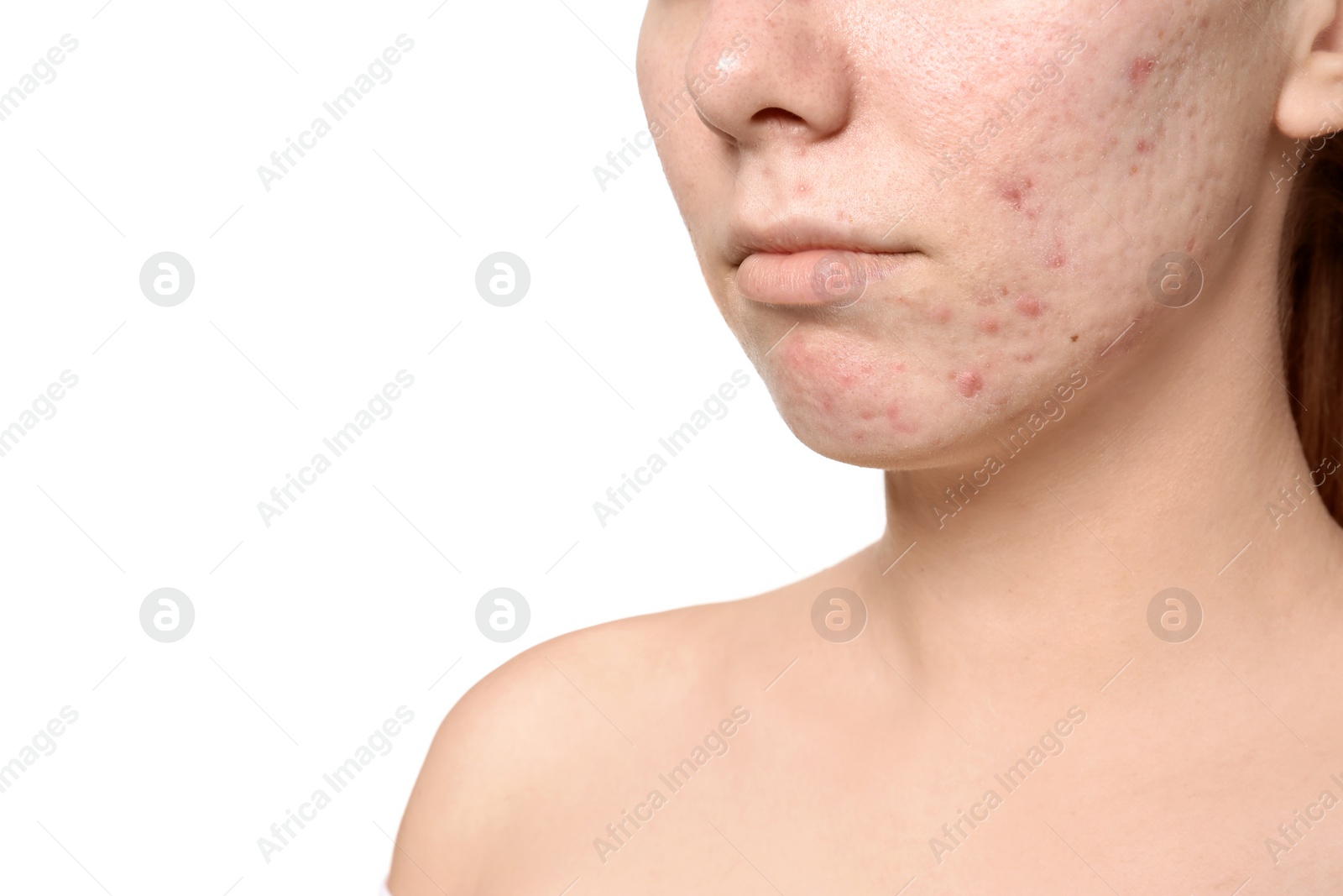 Photo of Young woman with acne problem on white background