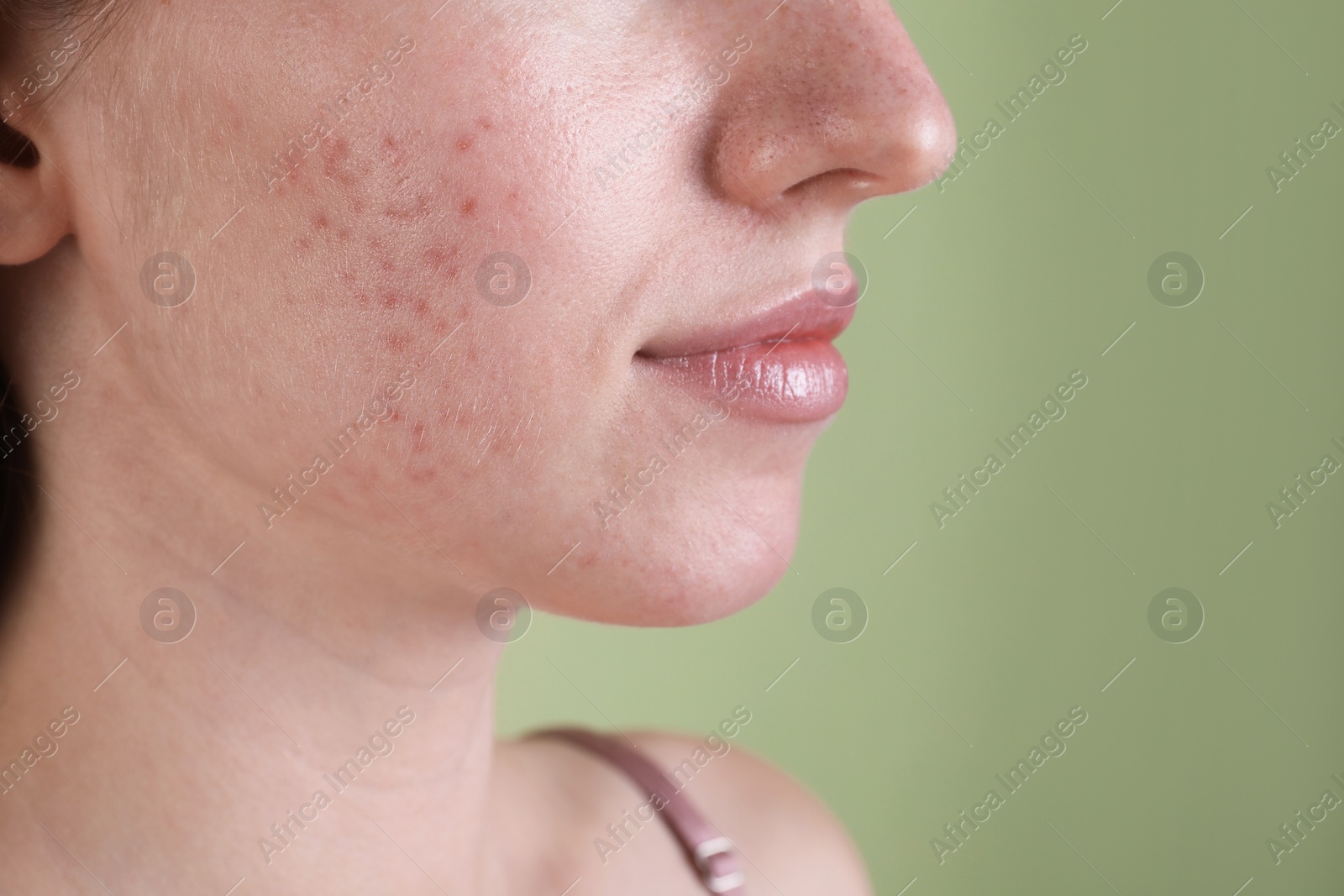 Photo of Young woman with acne problem on olive background, closeup. Space for text