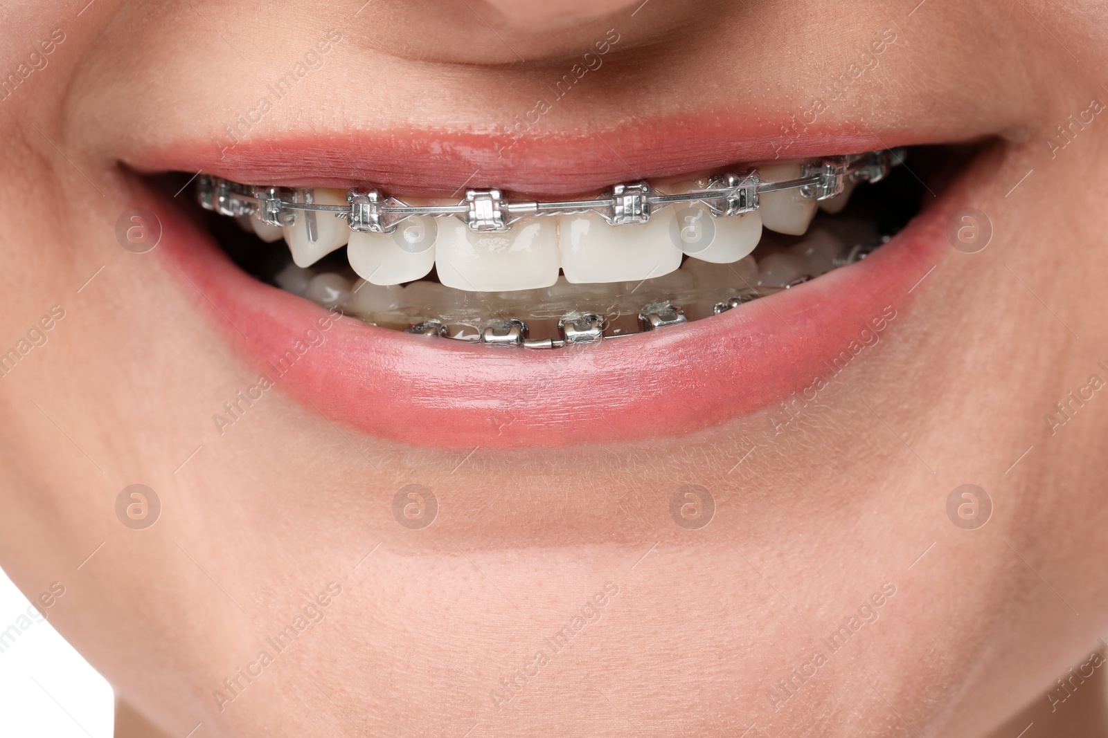 Photo of Smiling woman with dental braces, closeup view