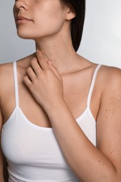Photo of Closeup view of woman`s body with birthmarks on light grey background