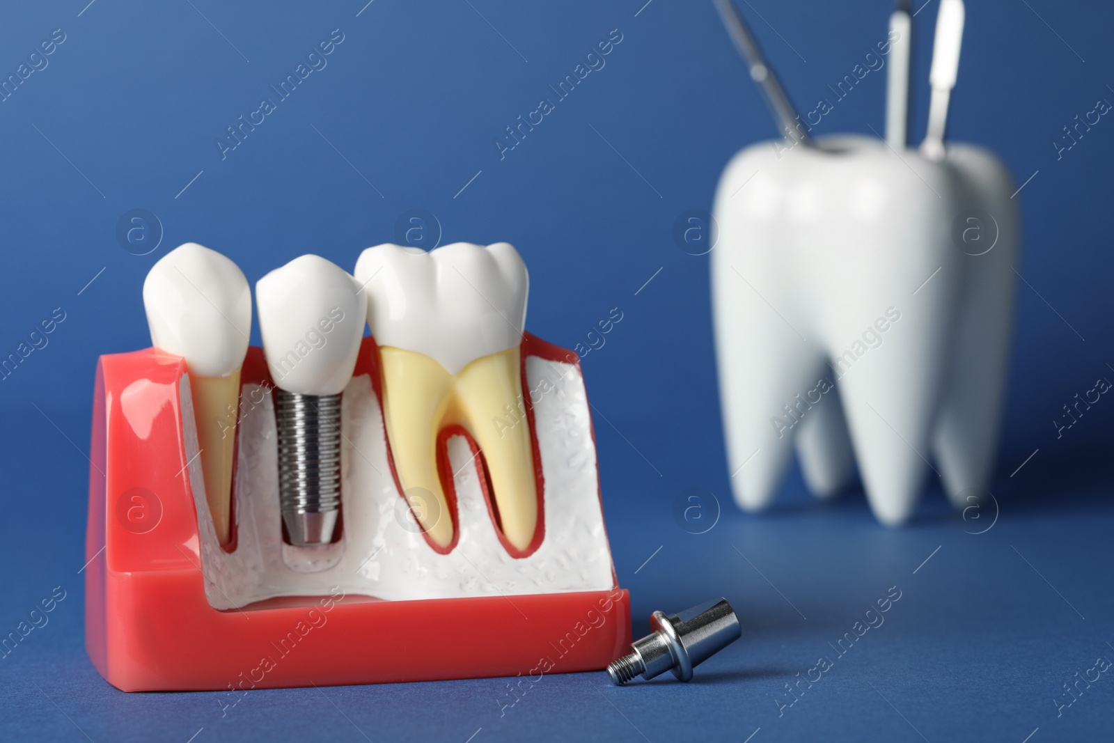 Photo of Educational model of gum with dental implant between teeth on blue background. Space for text