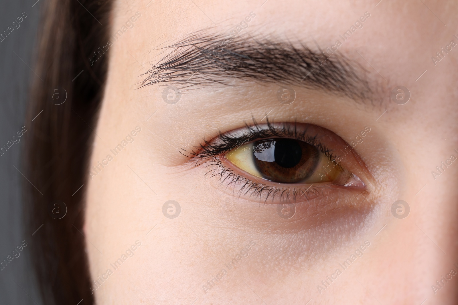 Photo of Woman with yellow eyes on grey background, closeup. Symptom of hepatitis