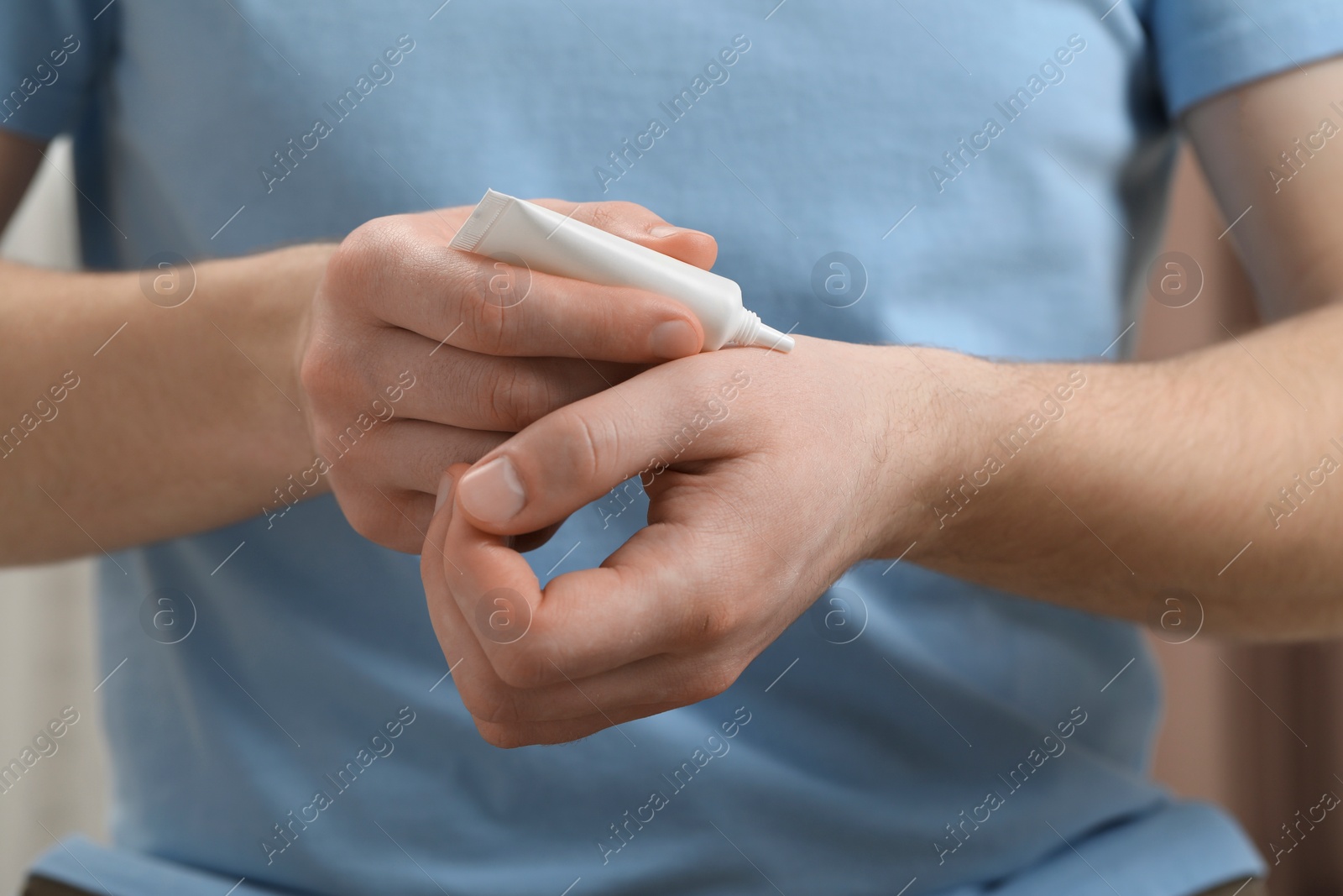 Photo of Man applying ointment from tube onto his wrist, closeup