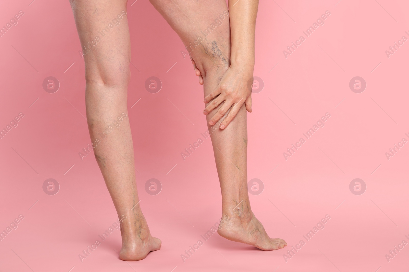 Photo of Closeup view of woman suffering from varicose veins on pink background