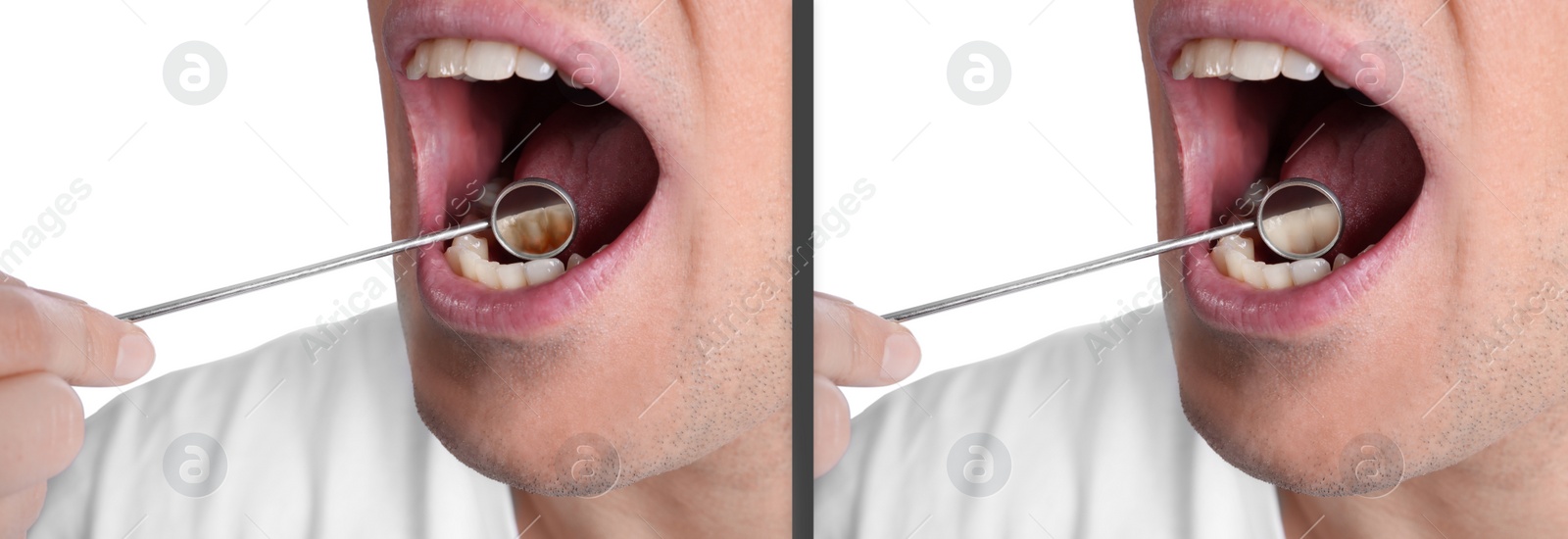 Image of Collage with photos of man before and after professional treatment of dental plaque on white background, closeup. Banner design