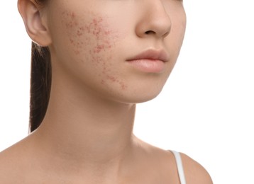 Photo of Teenage girl with acne problem on white background, closeup