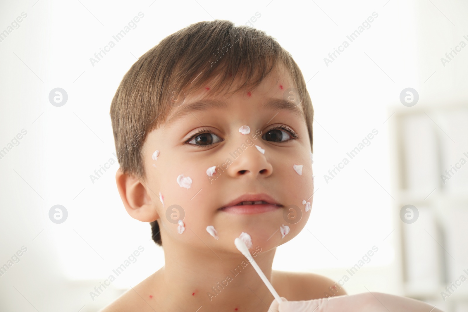 Photo of Doctor applying cream onto skin of little boy with chickenpox in clinic. Varicella zoster virus