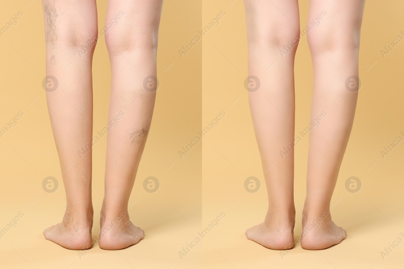 Image of Before and after varicose veins treatment. Collage with photos of woman showing legs on yellow background, closeup