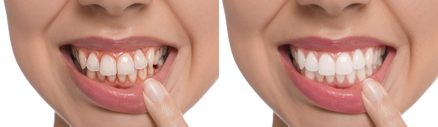 Image of Collage with photos of young woman before and after dental treatment on white background, closeup. Banner design