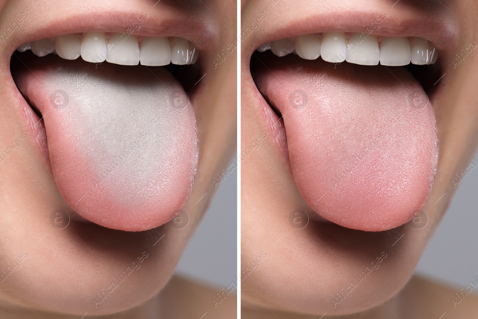 Image of Woman showing her tongue before and after cleaning procedure, closeup. Tongue coated with plaque on one side and healthy on other, collage