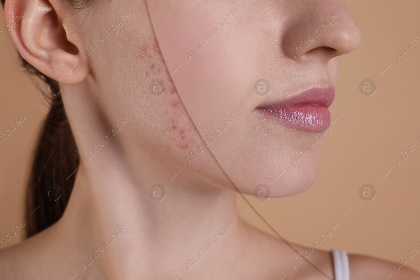 Image of Acne problem, collage. Photo of woman divided into halves before and after treatment on beige background, closeup