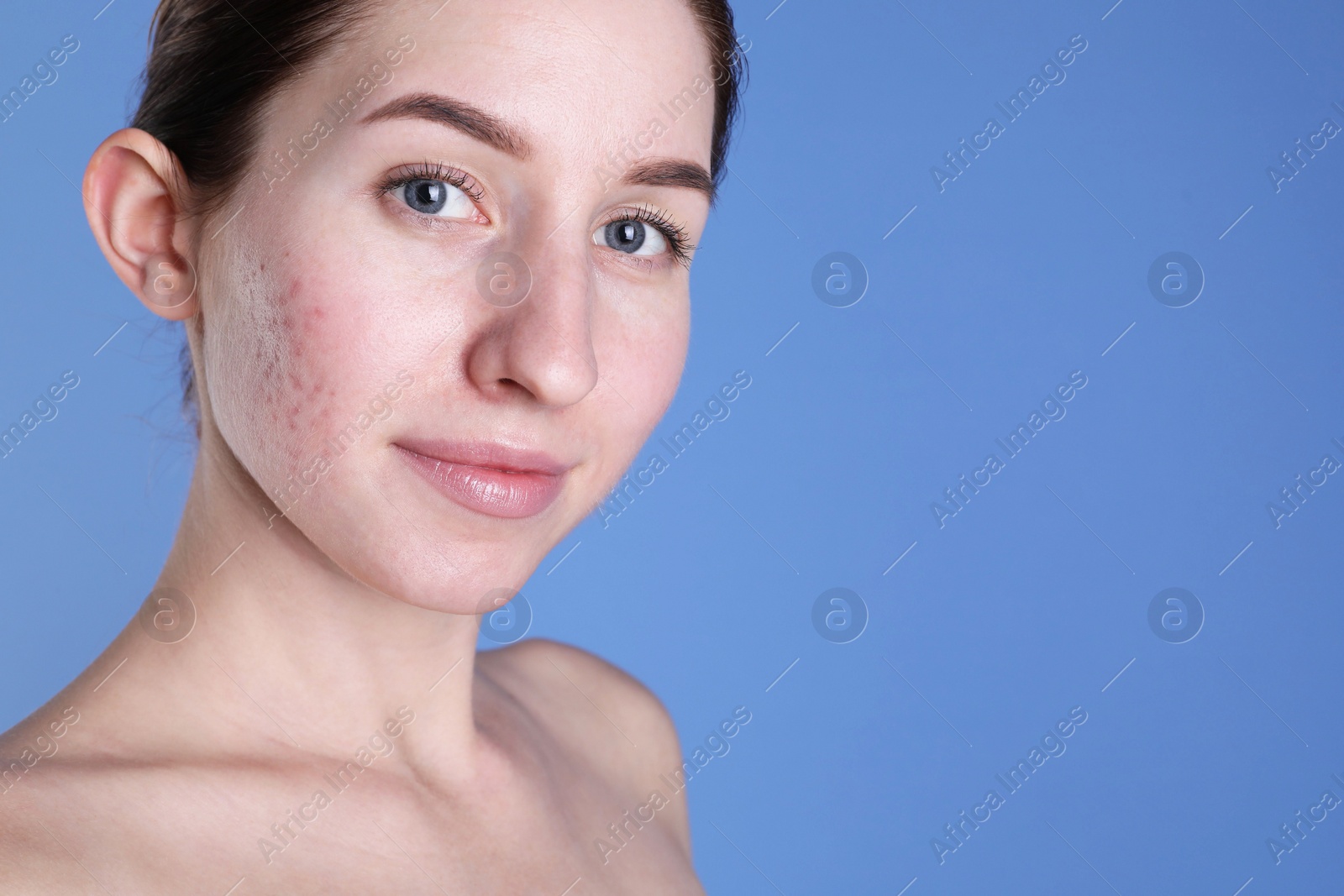 Photo of Young woman with acne problem on blue background. Space for text