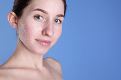 Photo of Young woman with acne problem on blue background. Space for text