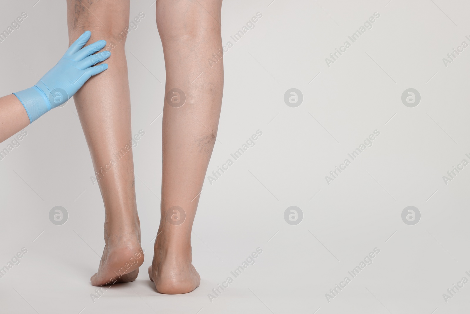 Photo of Doctor examining patient with varicose veins on light background, closeup. Space for text