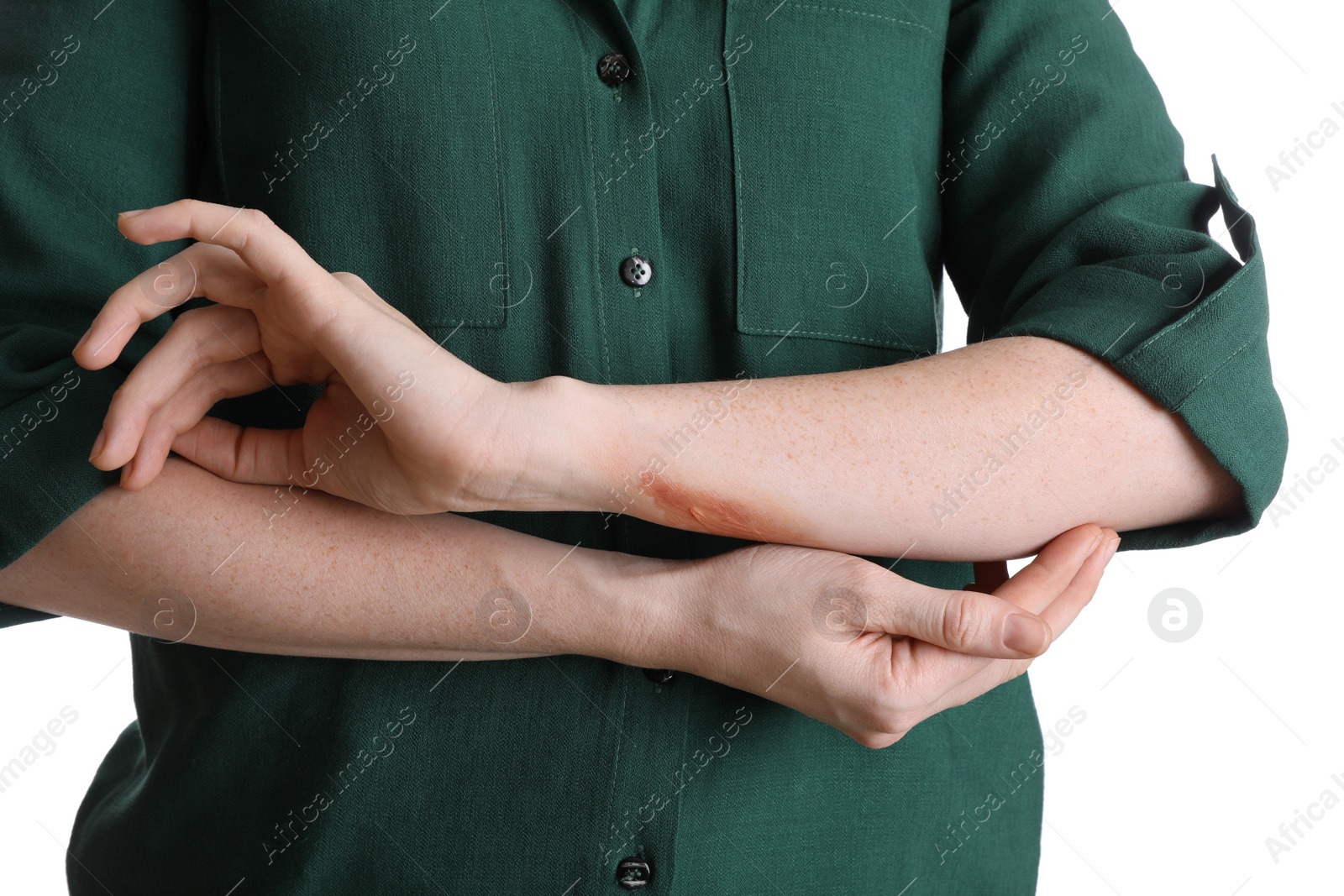 Photo of Woman with burned hand on white background, closeup