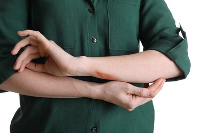 Woman with burned hand on white background, closeup