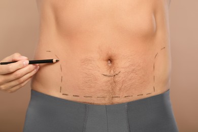 Doctor with pencil preparing patient for cosmetic surgery operation on light brown background, closeup