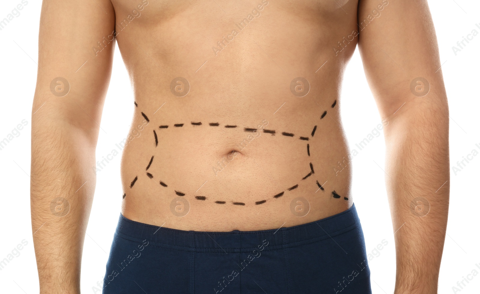 Photo of Young man with marks on belly for cosmetic surgery operation against white background, closeup