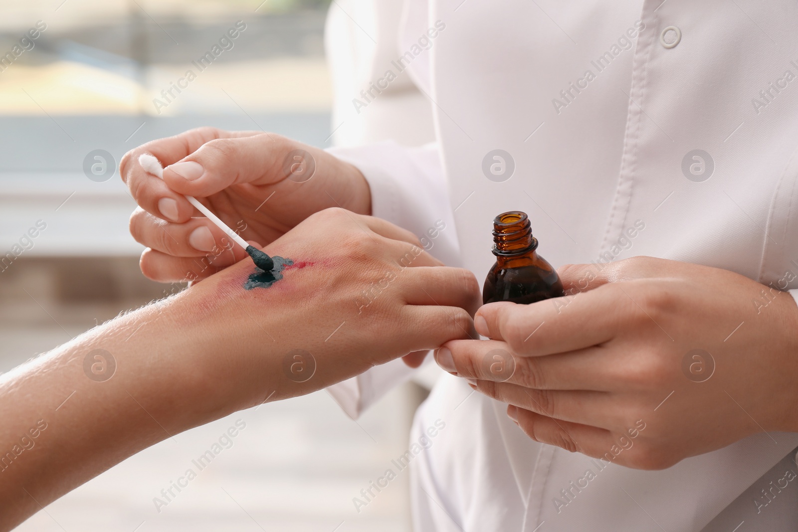 Photo of Doctor applying brilliant green onto injured hand indoors, closeup