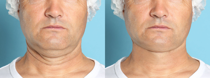 Image of Mature man before and after plastic surgery operation on blue background, closeup. Double chin problem