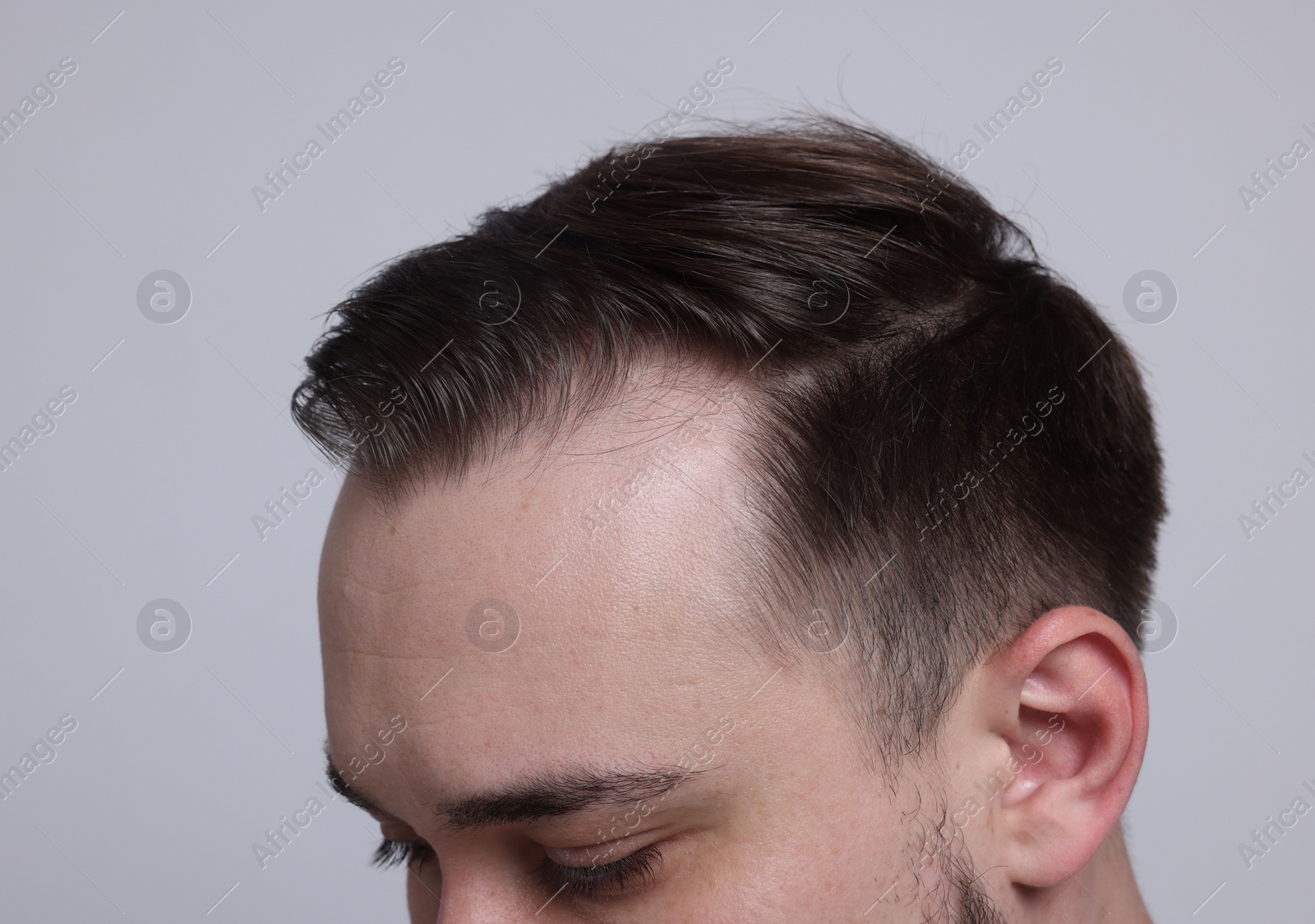 Photo of Baldness concept. Man with receding hairline on light grey background, closeup