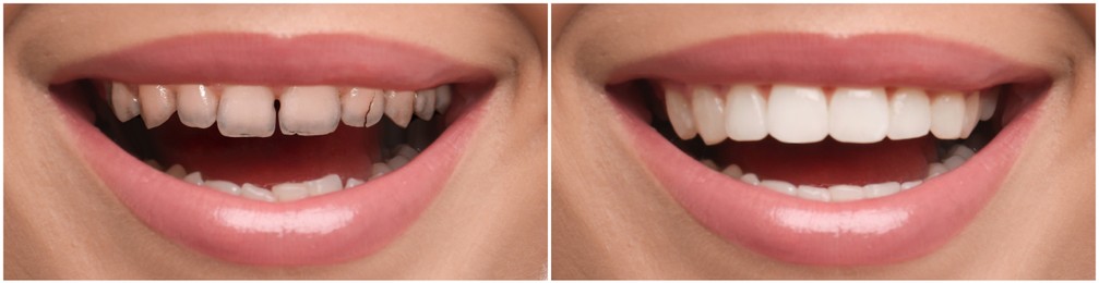 Collage with photos of young woman before and after dental treatment, closeup. Banner design