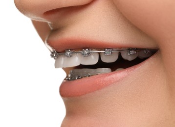 Smiling woman with dental braces on white background, closeup