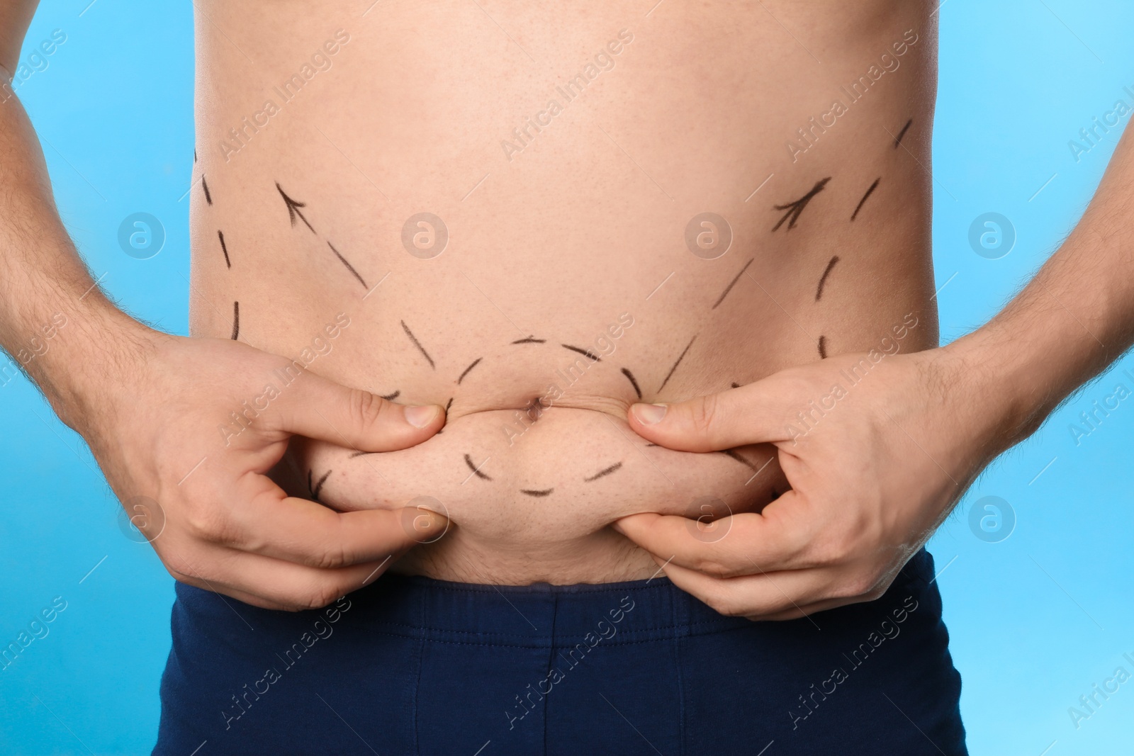 Photo of Man with marks on belly for cosmetic surgery operation against blue background, closeup