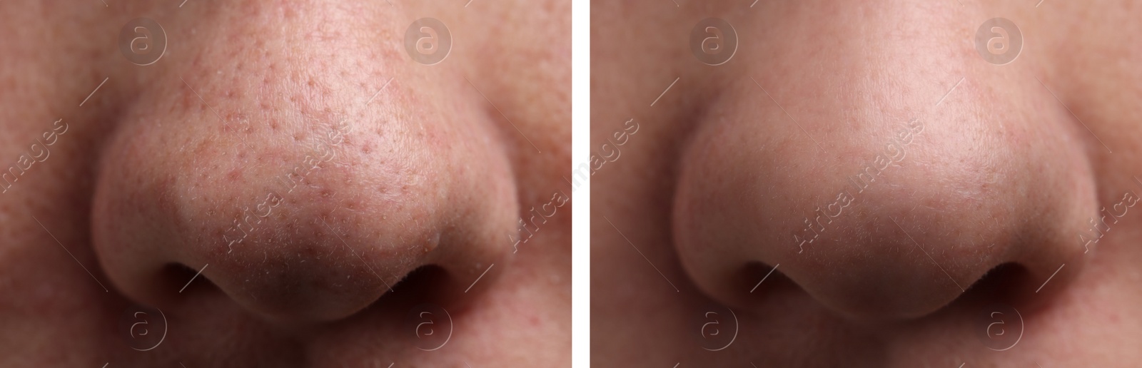 Image of Photos of man before and after acne treatment, closeup. Collage showing affected and healthy skin