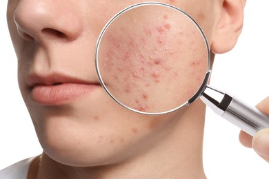 Dermatologist looking at man's face with magnifying glass on white background, closeup. Zoomed view on acne