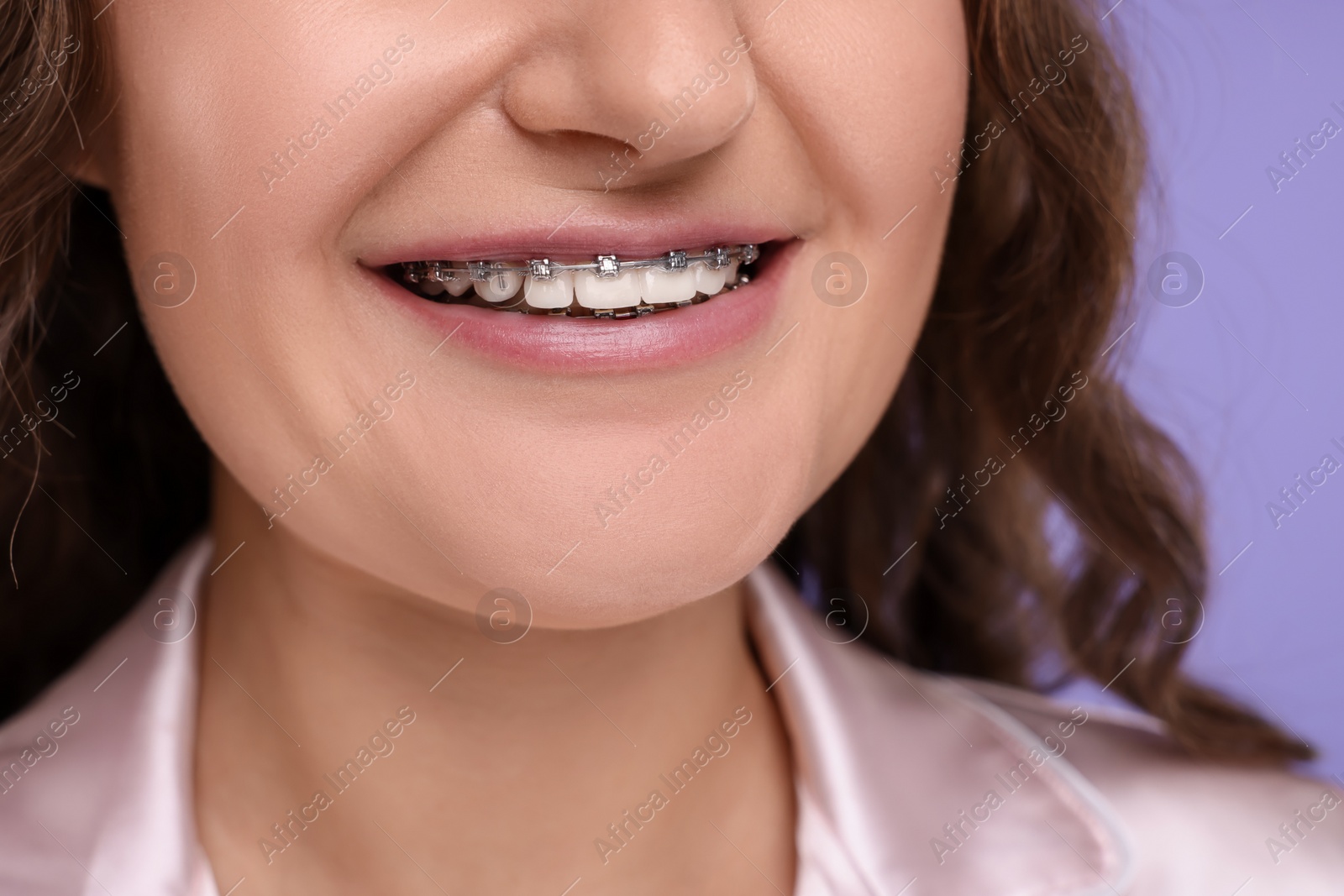 Photo of Smiling woman with dental braces on violet background, closeup