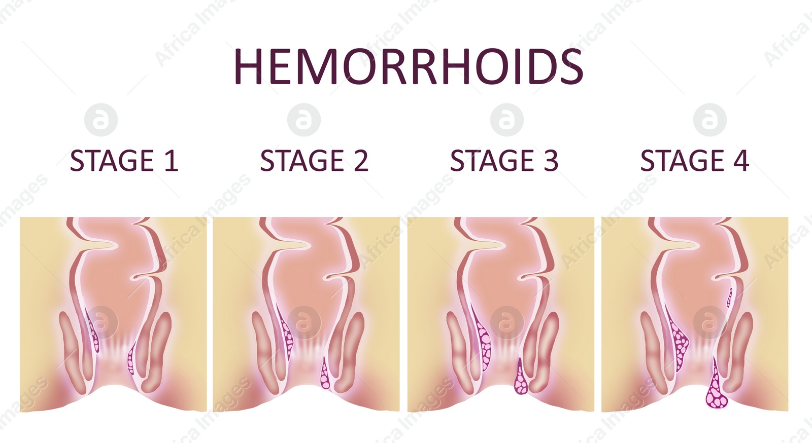 Image of Hemorrhoid stages. Illustration of unhealthy lower rectum with inflamed vascular structures, banner design