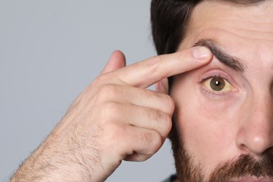 Photo of Man with yellow eyes on grey background, closeup. Symptom of hepatitis