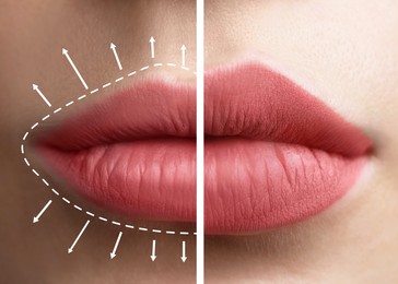 Image of Collage with photos of young woman before and after lips augmentation procedure, closeup