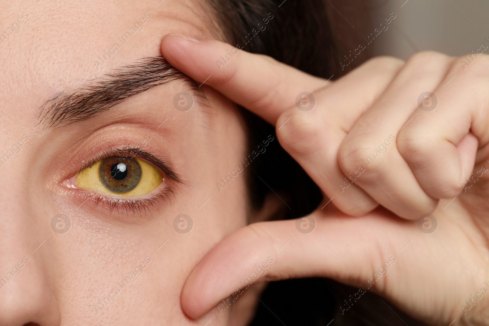 Photo of Woman with yellow eyes on blurred background, closeup. Symptom of hepatitis