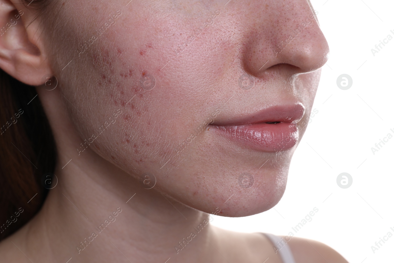 Photo of Young woman with acne problem on white background, closeup