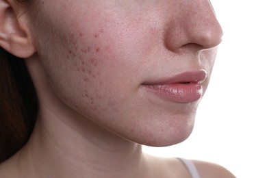 Photo of Young woman with acne problem on white background, closeup