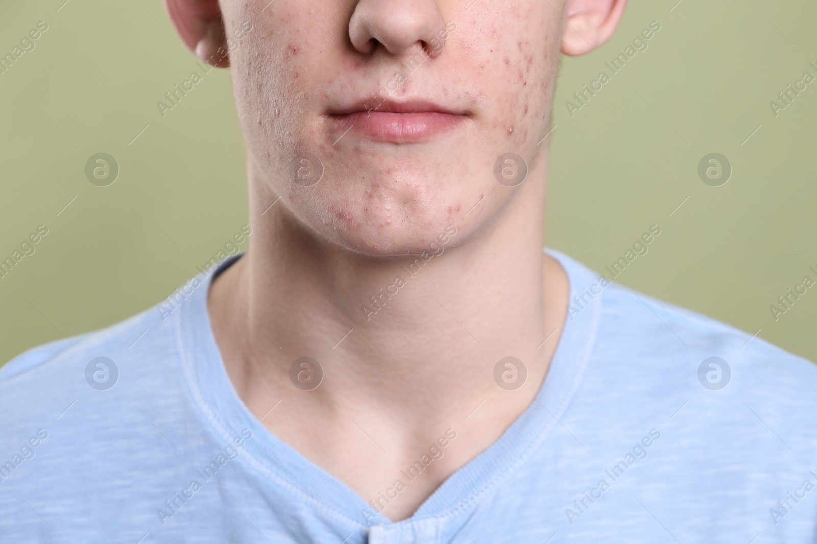 Photo of Young man with acne problem on olive background, closeup