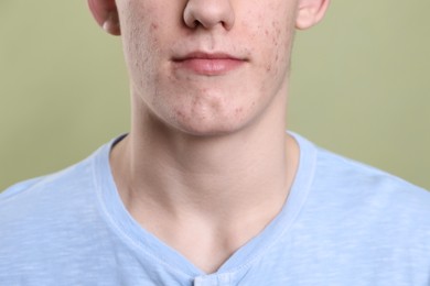 Young man with acne problem on olive background, closeup