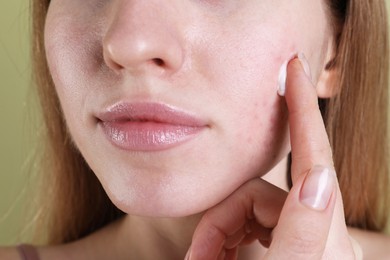 Young woman with acne problem applying cosmetic product onto her skin on olive background, closeup